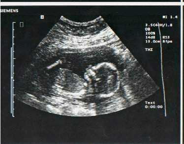 pregnancy-ultrasound-17-weeks1.jpg